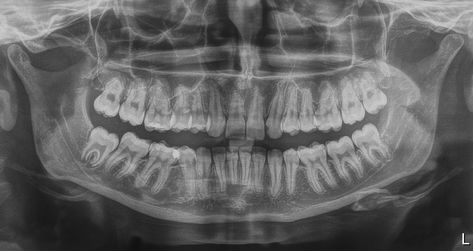 an xray of my teeth. Feel free to name em Teeth Xray, Skull Teeth, Aesthetic Skeleton, Teeth Aesthetic, Teeth Art, X Ray, Braces, Skeleton, Art