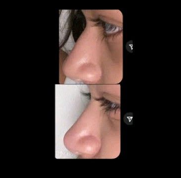 Subliminal Wl, Lips Subliminal Results, Subliminal Results Before And After Face, Nose Subliminal Results, Subliminal Results Nose, Subliminals Aesthetic, Subliminal Results, Upturned Nose, Wax Roller