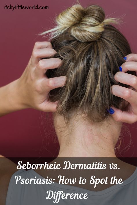 Itchy Scalp Remedy, Sores On Scalp, Home Remedies For Skin, Dry Itchy Scalp, Spot The Difference, Scalp Health, Dry Scalp, No Matter What, Matter