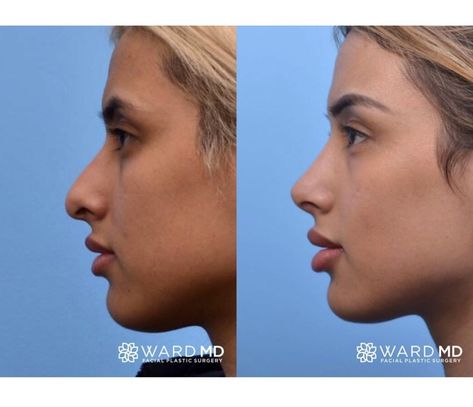 Ward MD Rhinoplasty Before & After ✨ This patient wanted to correct her droopy nasal tip, but did not want a scooped out or hollowed appearance to the bridge or dorsum of the nose. She felt that this gave a more natural look. As you can see we were able to rotate the tip of word while maintaining the natural look of her dorsum. Doesn't she look amazing?! Her nose is much more rounded out and her tip was brought up just a bit to make her nose compliment her facial features. 🥳 Nose Plastic Surgery, Nose Surgery Rhinoplasty, Nose Fillers, Bulbous Nose, Plastic Surgery Fail, Nose Jobs, Nose Types, Rhinoplasty Nose Jobs, Rhinoplasty Before And After