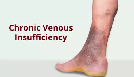 What is Chronic Venous Insufficiency? Home Remedies For Spiders, Leg Ulcers, Leg Veins, Venous Insufficiency, Types Of Surgery, Poor Circulation, Healthy Body Weight, Wound Care, Medical Knowledge