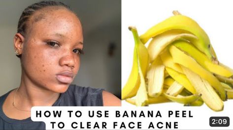 How to use banana to clear your acne’s, pimples Home Remedies For Face, Pimple Solution, Blind Pimple, Pimples Under The Skin, Prevent Pimples, Pimples Remedies, Pimples On Face, Acne Overnight, Acne Help