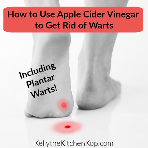 Do you know how to use apple cider vinegar to remove warts? It really works and I'm proof! I've even got a gross picture to prove it. Plantar Warts, Warts Removal, Remove Warts, Tag Remover, Allergy Remedies, Get Rid Of Warts, Dear Reader, Prove It, Cider Vinegar