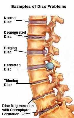 Lumbar Spondylosis & Prolapse Intervertebral Disc Homoeopathic Management Intervertebral Disc, Spinal Decompression, Bulging Disc, Spine Health, Spine Surgery, Human Skeleton, Sciatica Pain, Chiropractic Care, Neck Pain