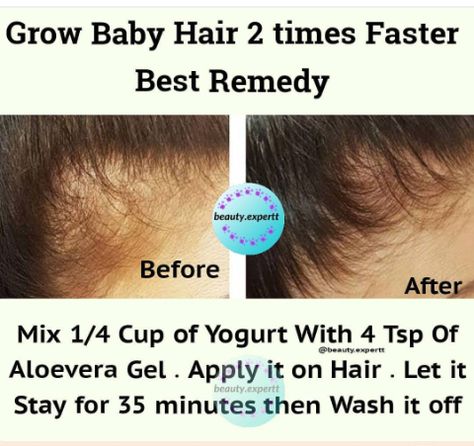 Forehead Hair Growth, Grow Baby Hair, Homemade Hair Treatments, Hair Care Remedies, Natural Hair Growth Tips, Natural Skin Care Remedies, Natural Glowing Skin, Good Skin Tips, Beauty Tips For Glowing Skin