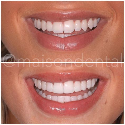 Edge Bonding Teeth, Composite Bonding Teeth, Teeth Composite, Slimmer Nose, Teeth Bonding, Composite Bonding, Bigger Lips, Pretty Teeth, Veneers Teeth