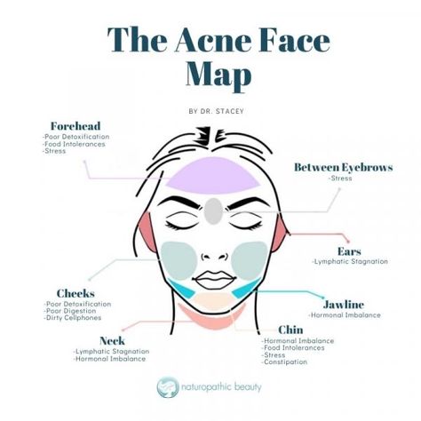 Acne Face Map, Clear Acne Naturally, Face Map, Clear Skin Diet, Face Mapping Acne, Skin Advice, Face Mapping, Acne Face, Naturopathic Doctor