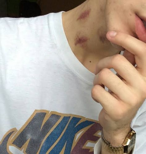 Hickey On Boy, Hickies Neck Aesthetic Guy, Hicks On Neck, Dean Di Laurentis, Hickies Neck, Vintage Disney Art, Kiss Mark, Inappropriate Thoughts, Love Bites