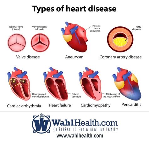 There are many types of heart diseases that can be avoided. Come in for an appointment today! Check out our website to learn more: www.WahlHealth.com Types Of Heart, Diet Schedule, Cardiac Nursing, Coronary Arteries, Heart Conditions, Nursing Study, Medical Knowledge, Cardiology, Cardiovascular Disease