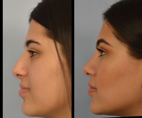 Closed Rhinoplasty, Nose Plastic Surgery, Nonsurgical Nose Job, Nose Surgery Rhinoplasty, Ethnic Rhinoplasty, Nose Fillers, Rhinoplasty Nose Jobs, Nose Reshaping, Rhinoplasty Before And After