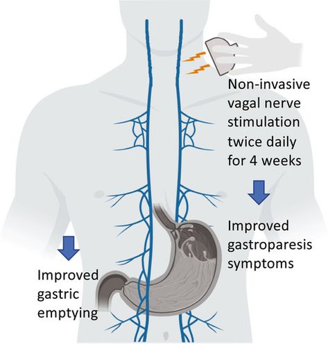 Short-term non-invasive vagal nerve stimulation can improve cardinal symptoms and accelerate gastric emptying in patients with idiopathic gastroparesis. Through its neuromodulatory and pro-kinetic ef... Vagal Nerve, Pilot Study, Gastric Problem, The Vagus Nerve, Gastric Juice, Gastrointestinal Disease, Rare Disorders, Healthy Remedies, Trigger Point Therapy