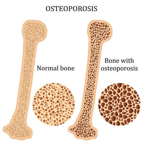 Normal Bone and Bone with Osteoporosis Comparison Bone Healing Foods, Osteoporosis Symptoms, Bone Healing, Eye Twitching, Weight Bearing Exercises, Nutrition Club, Bone Strength, Bone Loss, Healing Foods