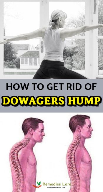 Hump Correction, Dowagers Hump, Dowager Hump, Dowager's Hump, Neck Hump, Posture Fix, Correct Posture, Healthy Man, Neck Exercises