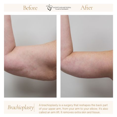 A brachioplasty is a surgery that reshapes the back part of your upper arm, from your arm to your elbow. It's also called an arm lift. It removes extra skin and tissue. Arm Lift Surgery, Pretty Nose, Too Much Estrogen, Arm Lift, Extra Skin, Body Exercises, Cool Sculpting, Fat Removal, Plastic Surgery