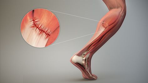 From Wikiwand: Strain (injury) Gastrocnemius Muscle, Calf Strain, Sports Physical Therapy, Calf Cramps, Calf Injury, Soft Tissue Injury, Muscle Strain, Shoulder Muscles, Muscle Spasms