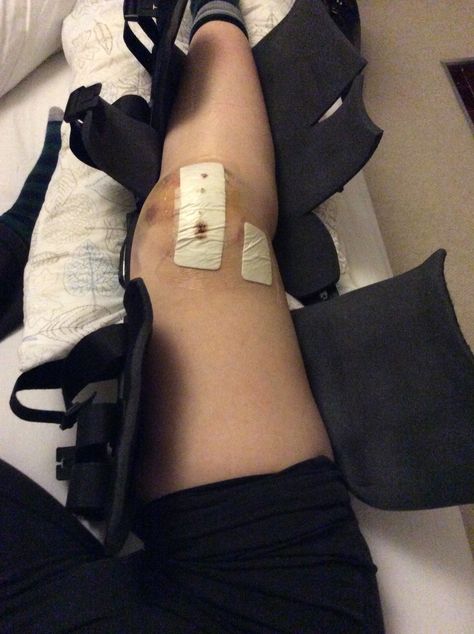 Trochleoplasty 4 days post op knee surgery #knees #postop #kneesurgery #trochleoplasty Acl Aesthetic, Dislocated Knee, Broken Knee, Candle Photography Dark, Surgery Aesthetic, Acl Recovery, Fake Injury, Basic Aesthetic, Friendship And Dating