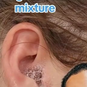 Dr. Sina Joorabchi on Instagram: "Peroxide in the ears for earwax . . . . . #earwax #earinfections #ears #health #reels #instagramreels" Squeezing Blackheads, Fluid In Ears, Ear Wax Removal, Inner Ear, Ear Cleaning, Ear Wax, September 16, Beauty Skin Care Routine, Natural Home Remedies