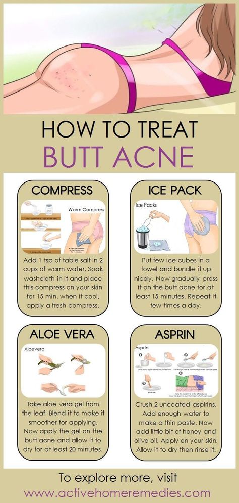 How to Treat Butt Acne Naturally - Fitness / Inspiration - #Akne #Treating ...  #fitness #inspiration #naturally #treat #treating Check more at http://3m.mrpublicdr.xyz/2019/09/03/how-to-treat-butt-acne-naturally-fitness-inspiration-akne-treating/ Forehead Acne, Acne Remedies, How To Get Rid Of Acne, Skin Care Remedies, Body Skin Care Routine, Diy Skin Care, Diy Skin, How To Treat Acne, Face Skin Care