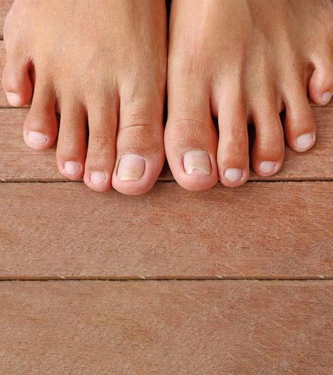 Unghie Malate, Toenail Pain, Infected Toenail, Nail Remedies, Mask For Oily Skin, Ingrown Toenail, Ingrown Nail, Fungal Nail, Homemade Hair Products