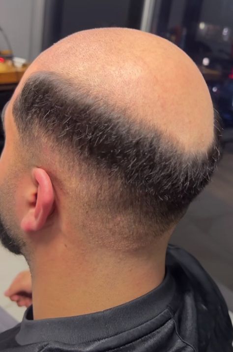 Follow @bald142 and get more of the good stuff by joining Tumblr today. Dive in! Male Pattern Baldness Hairstyles, Bald Memes Hilarious, Bald With Moustache, Female Pattern Baldness, Bald Look, Male Pattern Baldness, Pattern Baldness, Beards, Dive In