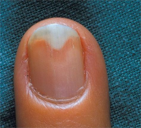 What Is Onycholysis? Nail Disorders, Nail Remedies, Split Nails, Fingernail Fungus, Nail Problems, Nail Fungus Remedy, Nail Infection, Fungal Nail, Nail Repair