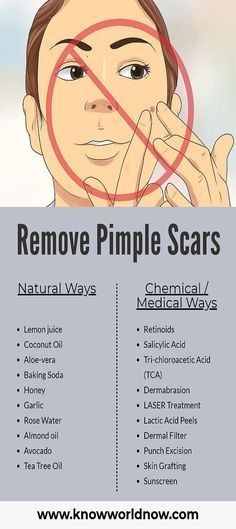 Pimple Scar Removal, Tea Tree Oil Skin, To Remove Pimples, Villain Arc, Remove Pimples, Pimples Under The Skin, Pimple Scars, Acne Overnight, Pimples Overnight