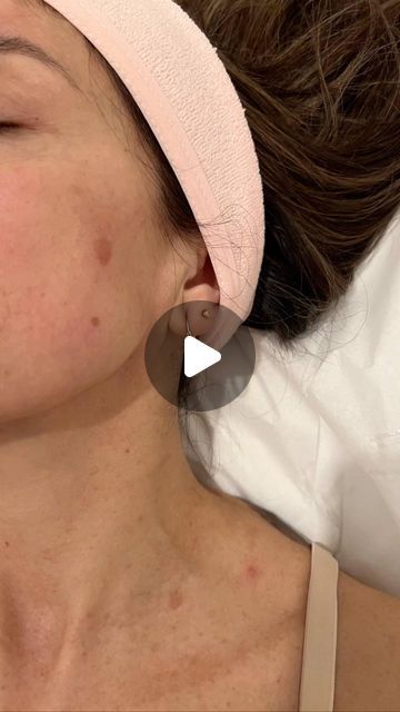 Markham Laser cosmetic on Instagram: "Amazing results with fractional laser, resurfacing, and other treatments as well." Fractional Laser, Laser Resurfacing, On Instagram, Quick Saves, Instagram