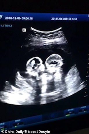 Identical twins are spotted 'fighting' in their mother's womb during an ultrasound scan  | Daily Mail Online Twins In The Womb, Four Months Pregnant, Twins Ultrasound, Baby Ultrasound, Baby Scan, Identical Twins, Black Picture, Twin Babies, Ultrasound