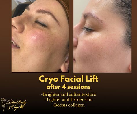 No need for needles or injections... -Improves texture -Adds elasticity -Feels and looks tighter -Boosts collagen -Brighter complexion Ready for your Cryo Facial Lift?Text or call us now to book your first session!📞 • • • 📞 (714)267-1998 🌐 https://try.cryoskin.co/total-body-and-cryo/ 📩TotalBodyAndCryo@gmail.com Cryo Facial, Body Sculpting, Total Body, Skin Firming, Facial, Skin Care, Texture, Feelings, Skin