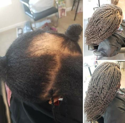 Single Crochet Braids My Client has Alopecia in her crown area. Do you have Hairloss and need a New Hairstyle? If so Contact me Now. I can Help! AKIYIA.COM #HairlossHelp #hairlosssolution #Crochetbraids #bohemianbraids #alopecia Single Crochet Braids, Braids For Alopecia, Bohemian Braids, New Hairstyle, Crochet Braids, Me Now, Single Crochet, New Hair, Winter Hats