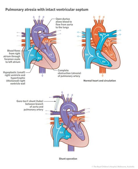 Pulmonary atresia with intact ventricular septum Obstetrics Nursing, Congenital Heart Defect Awareness, Chd Awareness, Congenital Heart Defect, Heart Defect, Cardiac Nursing, Congenital Heart, Nursing Study, Cardiovascular System