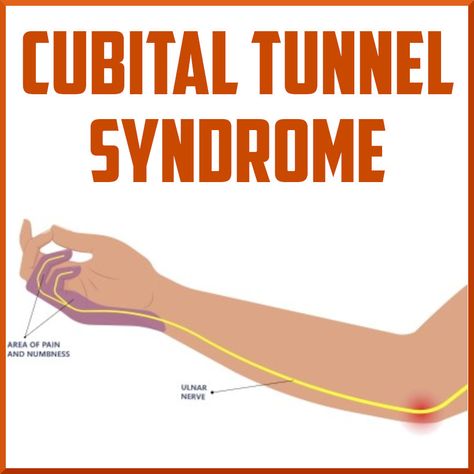 A Review of Cubital Tunnel Syndrome Cubital Tunnel Syndrome, Nerve Conduction Study, Ulnar Nerve, Elbow Pain, Degenerative Disease, Therapy Equipment, Sports Medicine, Ultrasound, Physical Therapy