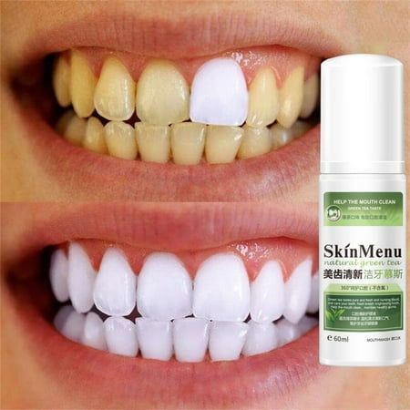 Natural Remove Stain Yellow Teeth White Tooth Cleaning Oral Mouth Spray 60ml, Size:One size Natural Teeth Whitening Diy, Denture Cleaner, Dental Bleaching, Mouth Spray, Teeth Whitening Homemade, Tooth Cleaning, Teeth Whitening Remedies, Teeth Whitening Diy, Deep Exfoliation