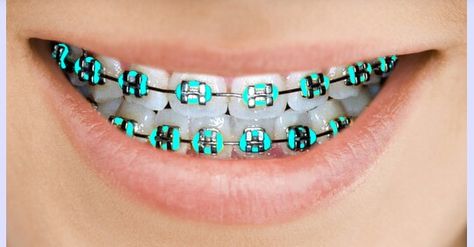 And even more Braces Colors Combinations, Invisible Teeth Braces, Fake Braces, Natural Teeth Whitening Diy, Braces Bands, Cute Braces Colors, Types Of Braces, Adult Braces, Braces Tips