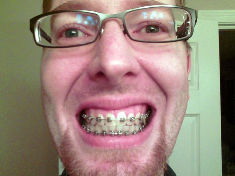 Why not go all the way with glasses & braces? Braces And Glasses, Guys With Braces, Adult Braces, Metal Braces, Perfect Teeth, Braces, All The Way, The Way, Quick Saves