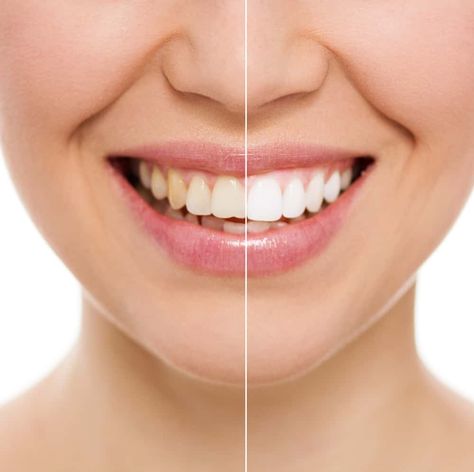 Whitening your teeth naturally is simple to do! With these simple DIY tips, you can have the brightest smile in the room in no time at all! #naturallywhitenyourteeth #brightsmile #whitenyourteeth #DIY #homemadeteethwhitener Make Teeth Whiter, Natural Teeth Whitening Diy, Get Whiter Teeth, Teeth Whitening Diy, Teeth Whitening Toothpaste, Teeth Whitening Gel, Charcoal Teeth Whitening, Teeth Bleaching, Teeth Whitening Strips