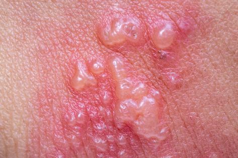 Shingles gets its name from the stripe-style rash it causes that looks like a shingle on a house. For most people, shingles resolves itself. About 20% of the time, it progresses to serious nerve damag Shingles Symptoms, Shingles Rash, Nerve Damage, Autoimmune Disorder, Nerve Pain, School Of Medicine, Let's Talk About, Primary Care, Dermatology