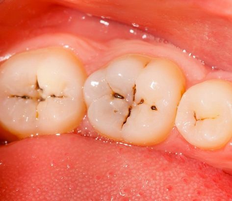 Tooth Caries, Rotten Teeth, Dental Photos, Dental Cavities, Weird Things, Dental Office, Tooth Decay, Healthy Teeth, Dental Clinic