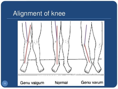 Genu Valgum, Genu Varum, Healthy Knees, Human Body