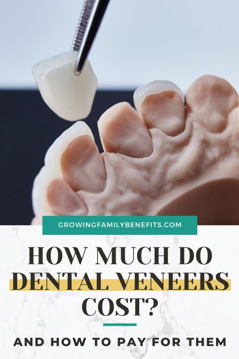 Dreaming of dental veneers but scared of the cost? Don't worry! Dental veneers can be expensive, but there are plenty of financing options to make them affordable. Whether it's monthly payment plans or no-credit-check alternatives like FSA financing and clip-in veneers, we've got the info you need. Find out the cost differences between porcelain veneers and composite veneers, get the details on the process, and learn how to afford those perfect teeth. Healthy Teeth Activities, Healthy Teeth Whitening, Affordable Dental Implants, Composite Veneers, Veneers Teeth, Porcelain Veneers, Perfect Teeth, Dental Veneers, Nice Teeth