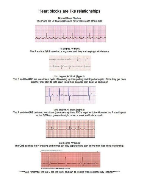 Heart blocks are like a relationship. Ekg Interpretation, Ems Humor, Nursing Fun, Pa School, Heart Blocks, Cardiac Nursing, Critical Care Nursing, Nurse Rock, Nursing School Tips