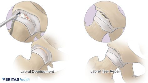 Surgery for Repairing a Torn Hip Labrum Torn Hip Labrum, Hip Labral Tear, Snapping Hip Syndrome, Torn Labrum, Shoulder Dislocation, Hip Injuries, Hip Problems, Hip Surgery, Types Of Surgery