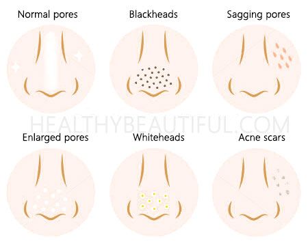 Top 5 Steps to Unclog Your Pores & Refine Your Skin - Healthy Beautiful Clogged Pores On Nose, How To Close Pores, Make Pores Smaller, Foot Detox Soak, Deep Clean Skin, Big Pores, Nose Pores, Deep Clean Pores, Essential Oils For Skin