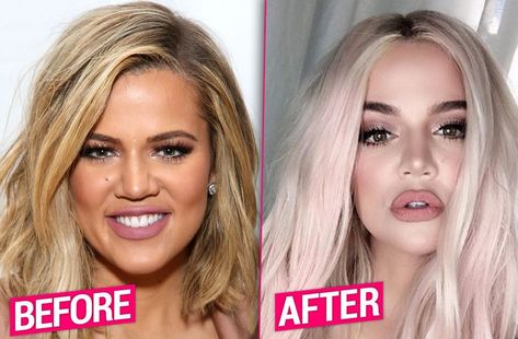 New Year, New Face! Khloe Unrecognizable After Invasive Plastic Surgery Overhaul Chloé Kardashian, Khloe Kardashian Plastic Surgery, Kardashian Plastic Surgery, Rhinoplasty Recovery, Facelift Without Surgery, Celebrity Surgery, Bad Plastic Surgeries, Kim And Kylie, Plastic Surgery Photos