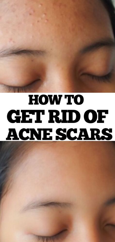 💯 how to get rid of breakouts, fine lines in skin, treatments for under eye lines 👍 #selfconfidence #scrub #sensitiveskin How To Remove Acne Marks, Open Pores On Face, Nose Acne, Get Rid Of Pores, Pimples Under The Skin, Get Clear Skin, Acne Prone Skin Care, Nose Pores, Pimples On Face