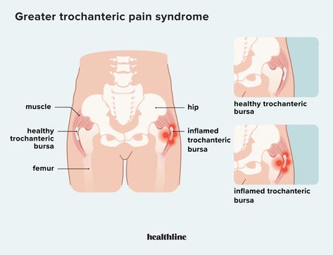 Greater Trochanteric Pain Syndrome, Snapping Hip Syndrome, Leg Spasms, Greater Trochanter, Bursitis Hip, It Band Stretches, Outer Thigh, Types Of Surgery, Hip Muscles