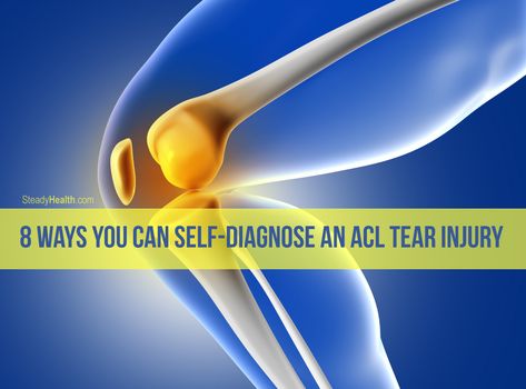 Self-diagnosis of an ACL tear injury is not an easy task. For a correct diagnosis, a combination of symptoms, signs, and examination are required. If you suspect an ACL tear injury it is important to visit a physician for a proper examination. Acl Tear Symptoms, Knee Exercise, Acl Injury, Acl Tear, Occupational Therapy Activities, Kinesiology Taping, Knee Exercises, Yoga Videos, Occupational Therapy