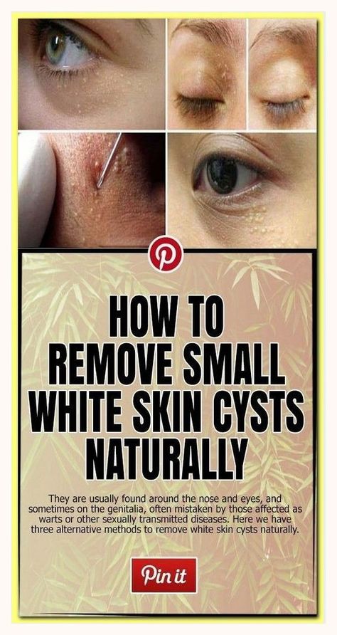 How to Remove Skin Tag in 1 Night Healthy Book, Cold Medicine, Losing 40 Pounds, Home Remedy For Cough, Cold Sores Remedies, Natural Sleep Remedies, Healthy Advice, Natural Cold Remedies, Cold Home Remedies