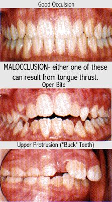 Correct Tongue Thrust Tongue Exercises, Tongue Muscles, Tongue Thrust, Myofunctional Therapy, Buck Teeth, Mouth Breather, Teeth Alignment, Receding Gums, Nail Biting