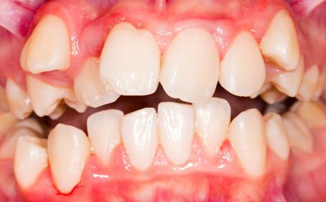 In this article we discuss the causes of Malocclusionthe symptoms and the treatment options availableAdvice from the experts at Coburg Dental Group Shaker Heights, Loose Tooth, Body Horror, This Is Your Life, Oil Pulling, Healthy Smile, Care Facility, White Teeth, Anatomy Reference